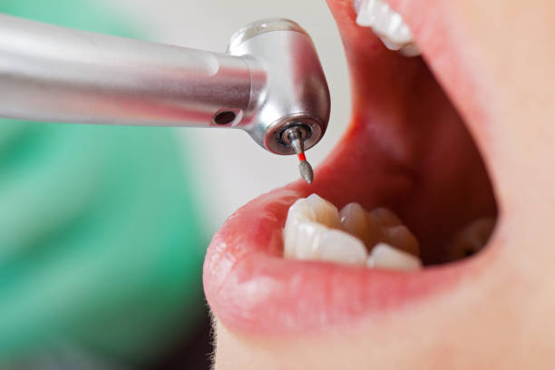 Best Emergency Tooth Extraction in Winter Springs, FL